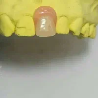 پروتز دندان دندانسازی تضمینی|آرایشی، بهداشتی، درمانی|صفادشت, |دیوار