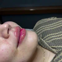 تزریق تخصصی ژل و بوتاکس  مشاوره رایگان|خدمات آرایشگری و زیبایی|اصفهان, خلیل آباد|دیوار