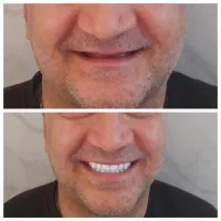 دندانسازی سیار (بیات پروتز) دندان مصنوعی