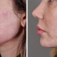 جذب مدل ژل صورت مخصوص فرمدهی و جوانسازی|خدمات آرایشگری و زیبایی|اندیمشک, |دیوار