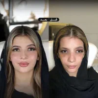 تزریق ژل و بوتاکس و‌پی آرپی لیفت صورت و اصلاح بینی