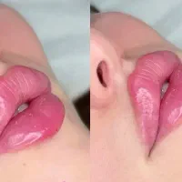 ژل لب گونه چانه،فول فیس لیفت نخ/لیزرآنزیم بوتاکس|خدمات آرایشگری و زیبایی|مشهد, هفت تیر (آب و برق)|دیوار