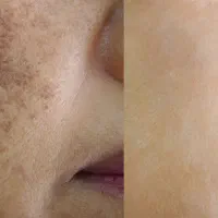 کرم ضدلک و‌جوش و سفید کننده|آرایشی، بهداشتی، درمانی|دهدشت, |دیوار