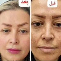 سرم ویتامین سی