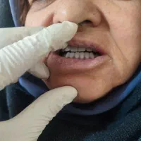 ساخت دندان از دست رفته