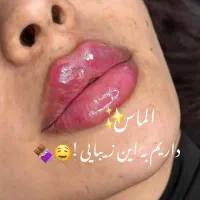تزریق ژل و بوتاکس