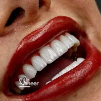 دندانپزشکی کامپوزیت ایمپلنت لمینت (بدون تراش)|خدمات آرایشگری و زیبایی|تهران, زعفرانیه|دیوار