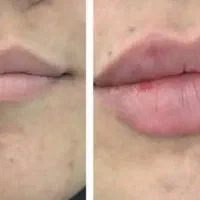 تزریقات زیبایی وجوانسازوفیلرها باتخفیف ویژه|خدمات آرایشگری و زیبایی|دوگنبدان, |دیوار