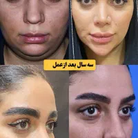 آف زیبایی لیپو ابدو عمل بینی ۱۹ میلیون|خدمات آرایشگری و زیبایی|خرمشهر, |دیوار
