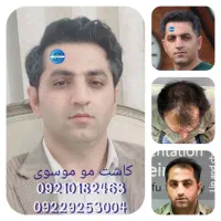 کاشت مو شیرازی