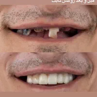 ساخت انواع دندان با بهتر کیفیت