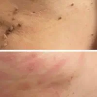 برداشتن خال زگیل میخچه باقیمت فوق العاده توسط پزشک