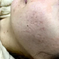 سابسیژن بافت اسکار