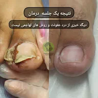 درمان بیماری های ناخن بدون جراحی درکلینیک|خدمات آرایشگری و زیبایی|قرچک, مهدیه|دیوار