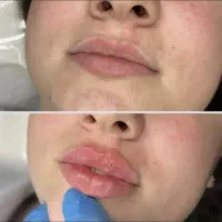 ژل. مزو ژل. جوانساز. بوتاکس|خدمات آرایشگری و زیبایی|کرج, حصارک پایین|دیوار