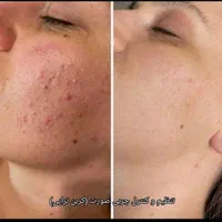 سفیدکردن بیکینی،زیربغل،صورت (کلینیک ایرانا)|خدمات آرایشگری و زیبایی|یاسوج, |دیوار