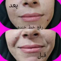 ژل و بوتاکس 550آموزش4م.باکمترین هزینه بدرخشید.|خدمات آرایشگری و زیبایی|شهریار, شهریار|دیوار