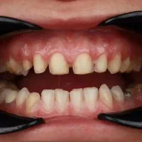 کامپوزیت دندان روکش لمینت با قیمت مناسب و اقساط|خدمات آرایشگری و زیبایی|ری, شهرری|دیوار