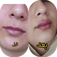 آموزش تتو بدن و  و ژل و بوتاکس باتخفیف 50%|خدمات آموزشی|مشهد, توس (بلوار توس)|دیوار