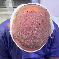 کاشت مو و ابرو و ریش در اردبیل اقساطی و تضمینی|خدمات آرایشگری و زیبایی|اردبیل, |دیوار