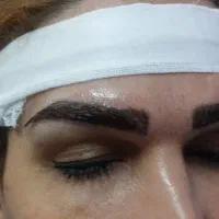 کاشت مو و ریش و ابرو