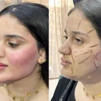 جوانسازی و حجم دهی صورت با کمترین هزینه|خدمات آرایشگری و زیبایی|مشهد, هفت تیر (حافظ)|دیوار