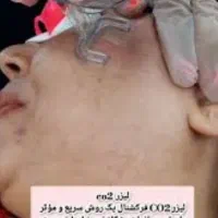 اولین مرکز لیزر با دو مدل دستگاه لیزر شاتی و رولی|خدمات آرایشگری و زیبایی|نجف‌آباد, باغ ملی|دیوار