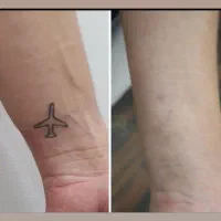 ریموو تاتو صورت و بدن با لیزر کیوسوییچ امریکایی