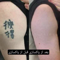قویترین پاکسازی تاتو.درمان لک.ماه گرفتگی.کربنتراپی|خدمات آرایشگری و زیبایی|یاسوج, |دیوار