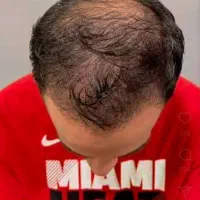 درمان قطعی ریزش مو و رد مجدد مو با پکیج درمانی H3|خدمات آرایشگری و زیبایی|شاهین‌شهر, خانه کارگر|دیوار