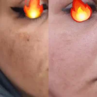 لیزر موفیشال لاغری پوست فیلر بوتاکس ویژه بانوان