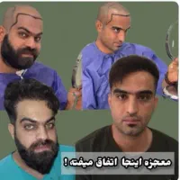 تخفیف ویژه کاشت مو بدون بخیه سوپر fitنوبت محدود