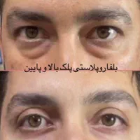 مژده همشهریان عزیزتخفیف 30 درصد خدمات جراحی ساکشن