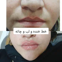بوتاکس ژل فیلر فیلربادی مزوتراپی پی آر پی در مطب|خدمات آرایشگری و زیبایی|زنجان, |دیوار