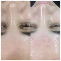 آموزش وخدمات فشیال پوست|خدمات آرایشگری و زیبایی|مبارکه, |دیوار