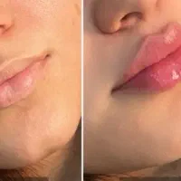 فیلر صورت فرصت ویژه ،فقط هزینه مواد