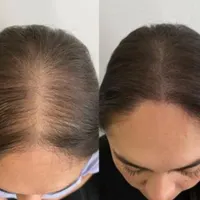 PRP/prpمو/prpصورت/درمان ریزش مو/درمان لک|خدمات آرایشگری و زیبایی|اصفهان, عباس‌آباد|دیوار