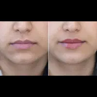 ژل لب فیلر بوتاکس مزو وآنزیم          زیرنظرپزشک|خدمات آرایشگری و زیبایی|مشهد, آزادشهر|دیوار