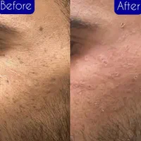 خال برداری و ضایعات پوستی در کلینیک معتبر|خدمات آرایشگری و زیبایی|کرمانشاه, |دیوار