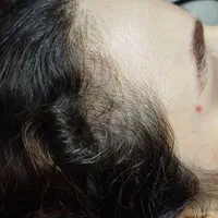 درمان ریزش مو|خدمات آرایشگری و زیبایی|رشت, بلوار گیلان|دیوار