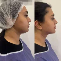 جشنواره تکرار نشدنی ساکشن غبغب و ..کلینیک پالادیوم|خدمات آرایشگری و زیبایی|شیراز, معالیآباد|دیوار