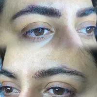 مدل میکروبلیدینگ رایگان