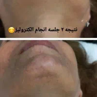 الکترولیز روشی قطعی حذف موهای زائد صورت|خدمات آرایشگری و زیبایی|اشنویه, |دیوار