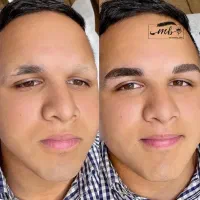 میکروبلیدینگ طبیعی آقایان