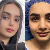 جراحی زیبایی بینی