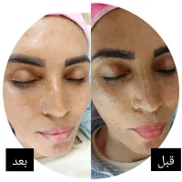 فیشیال تخصصی پوست با تخفیف باور نکردنی
