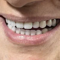 دست دندان مصنوعی