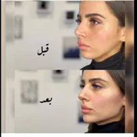 بوتاکس لیبل دار واحدی ۲۰۰ ژل اورجینال توسط پزشک|خدمات آرایشگری و زیبایی|اصفهان, احمدآباد|دیوار