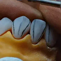 استخدام  پیک و کاراموز پسر در دندان سازی