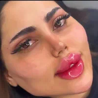 جشنواره ژل لب بوتاکس فیلر زاویه مزو کلینیک زیبایی